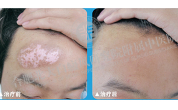 白癜風(fēng)為什么不容易治愈