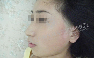 白癜風的早期癥狀有哪些