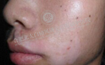 白癜風(fēng)康復(fù) 男孩快樂成長(zhǎng)