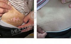 白癜風是病,得治!