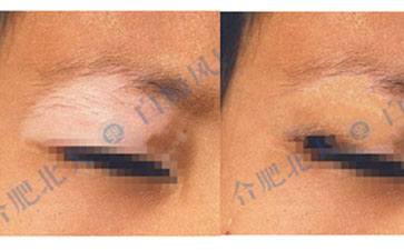 合肥白癜風患者復色案例