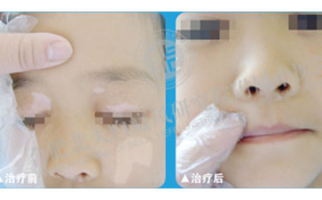 袪“白”成功,還孩子一個快樂的童年