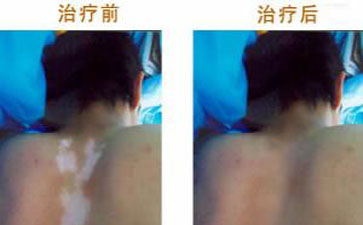 合肥白癜風患者復色案例
