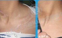 遠離白斑噩夢,找回自信陽光