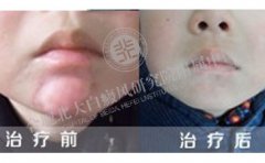 合肥白癜風患者復色案例